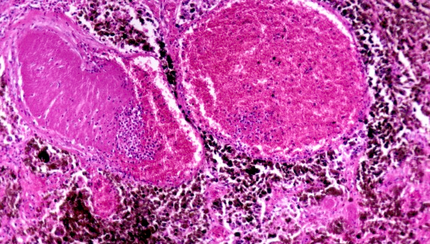 microscopic image of melanoma