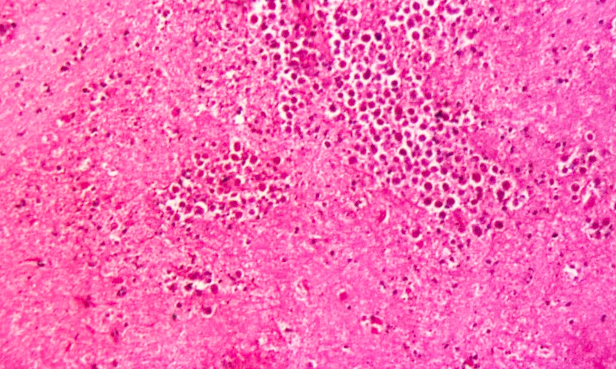 Brain infection amoeba