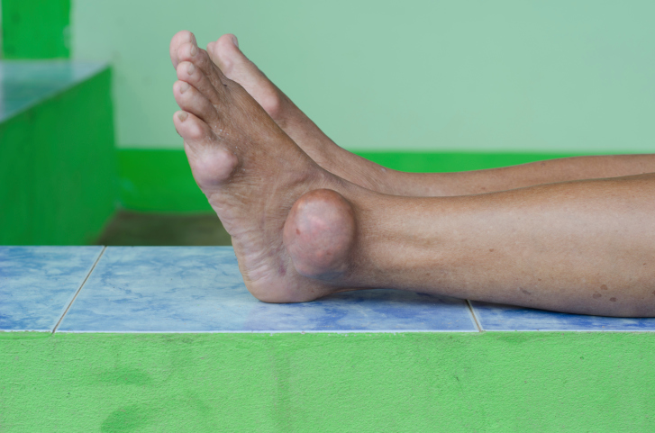 foot with gout