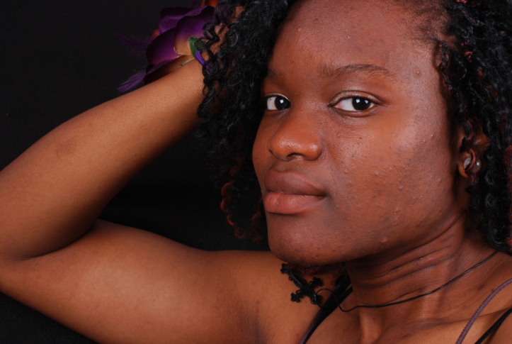 woman with acne