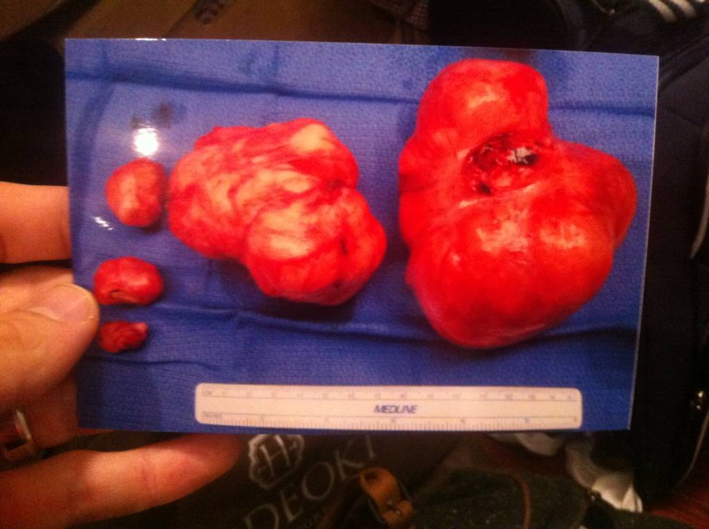 vunzai fibroids