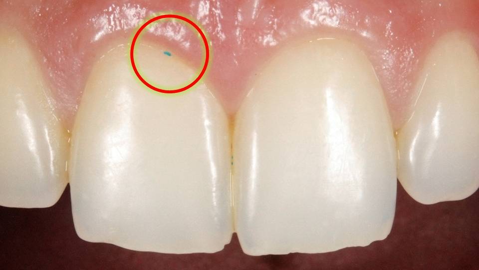 microplastic2