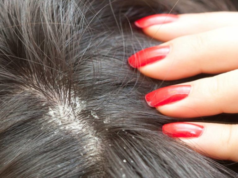 yeast infections on scalp