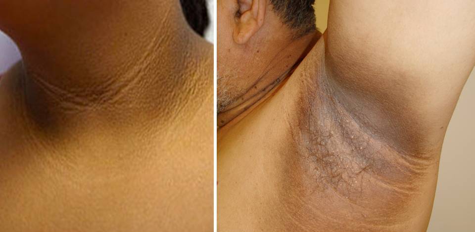 Acanthosis nigricans