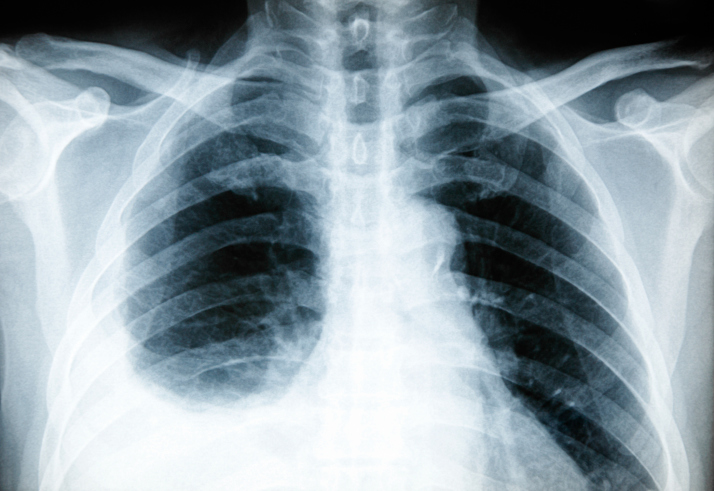 how to get rid of mucus in chest