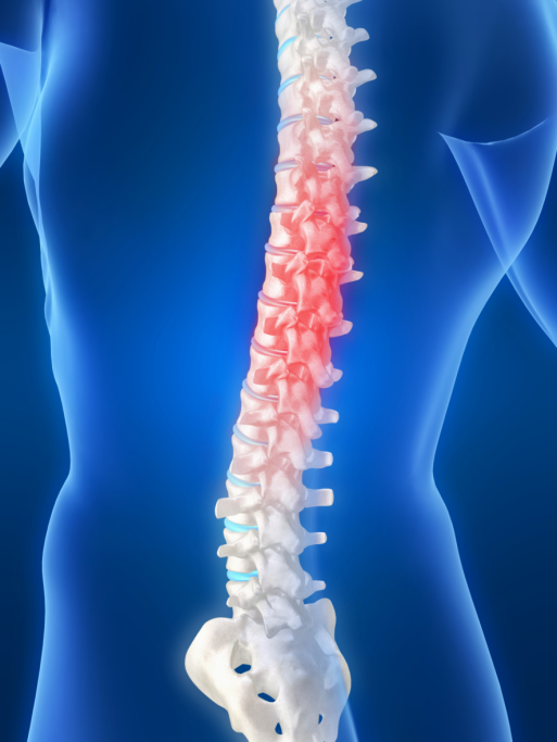 Sciatica