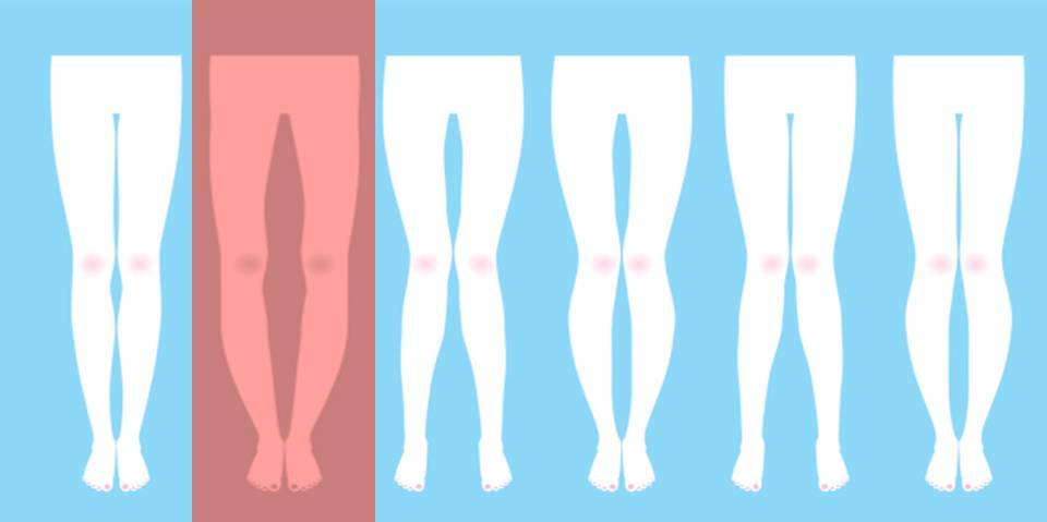 bowlegged