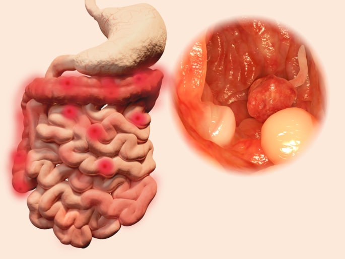 how to prevent colon cancer