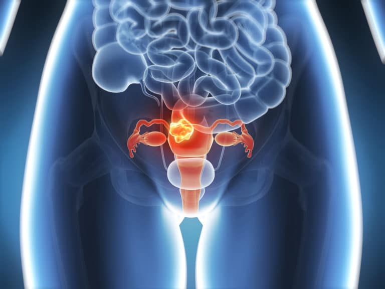 pcos and fibroids