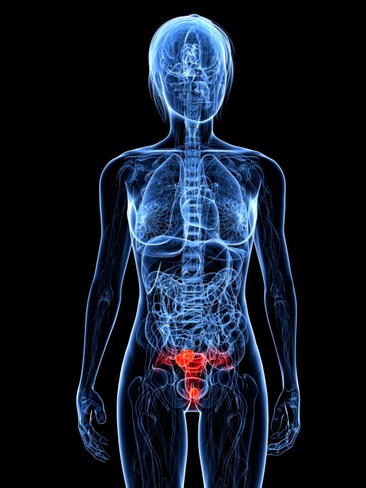 uterus cancer