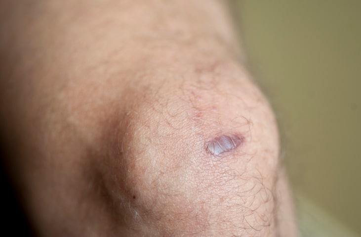 Remove Keloid Scars