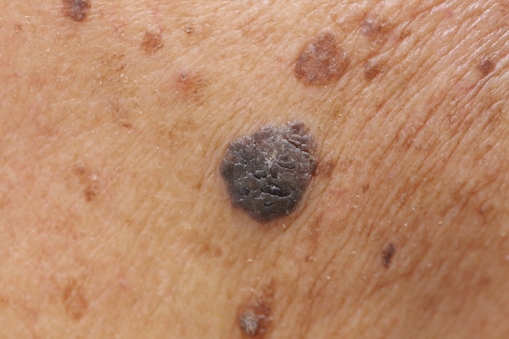 mole on skin