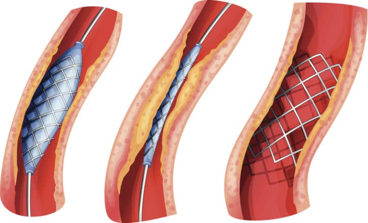 Stents