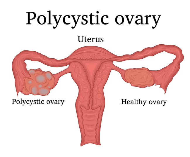PCOS and Diabetes