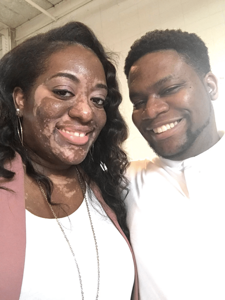 vitiligo