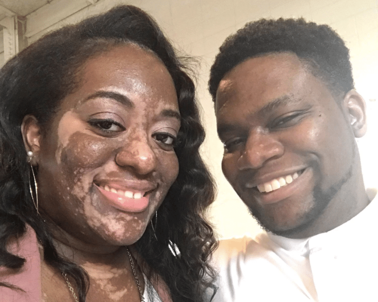 vitiligo