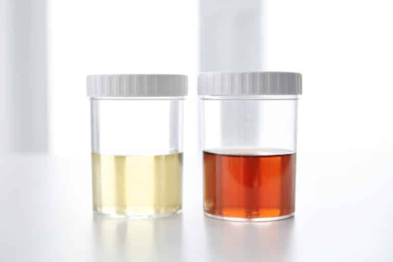Blood in human urine in sample pot