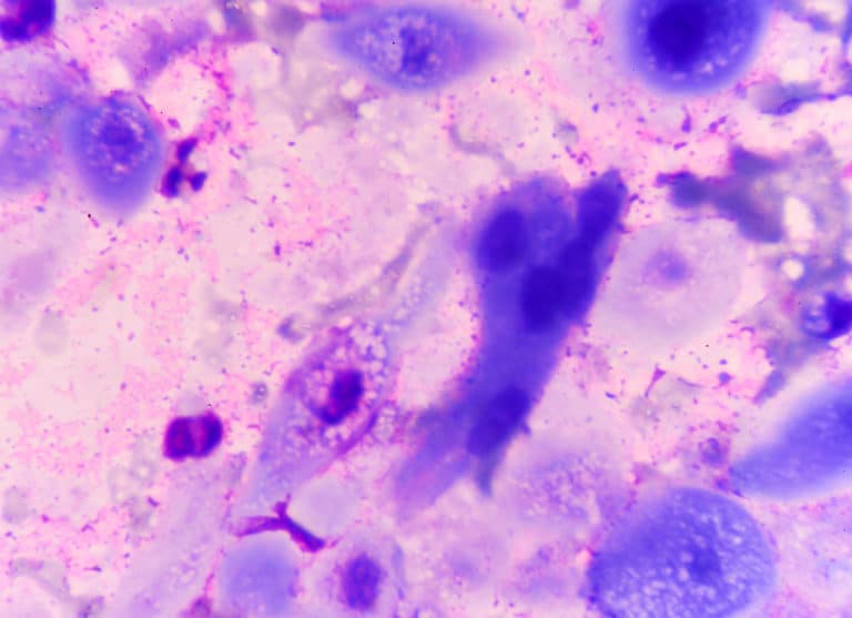 NAVIGATING THE DATA, TREATMENTS AND BREAKTHROUGHS OF HATTR AMYLOIDOSIS