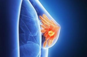 Breast Cancer
