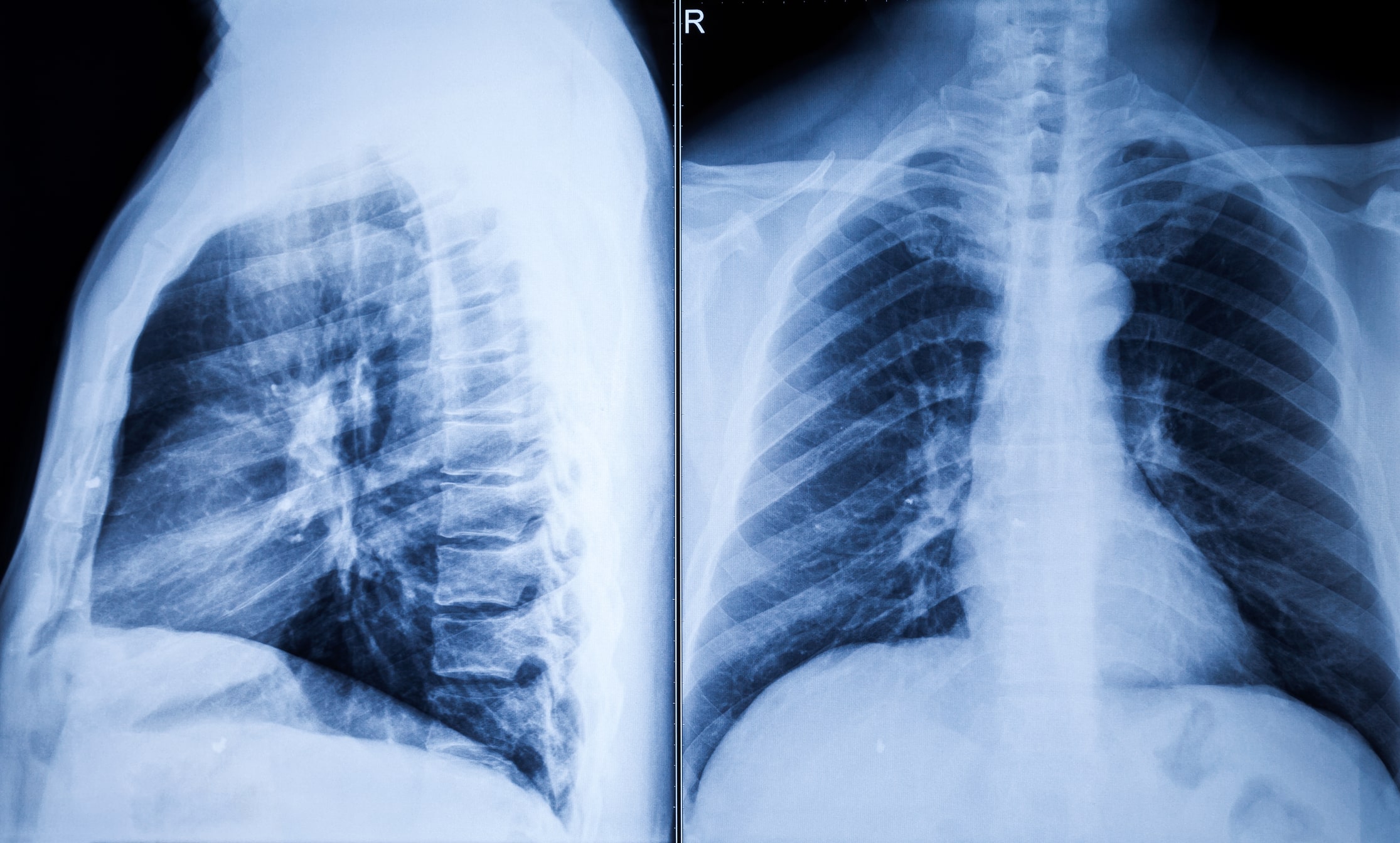 how to get rid of mucus in chest