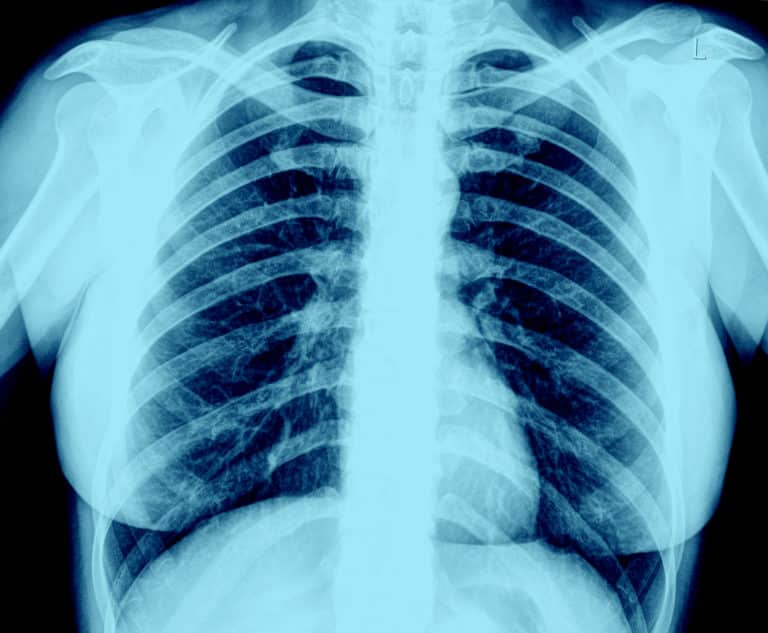 Late-Stage Lung Cancer