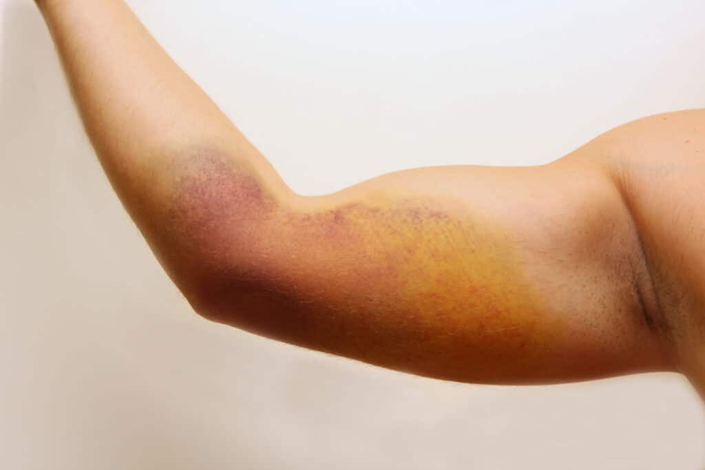 symptoms of blood clot in leg