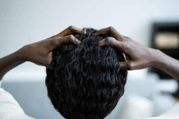 dandruff vs psoriasis