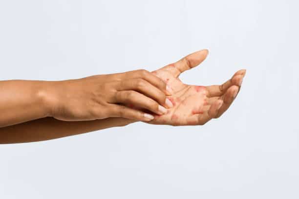 skin rash