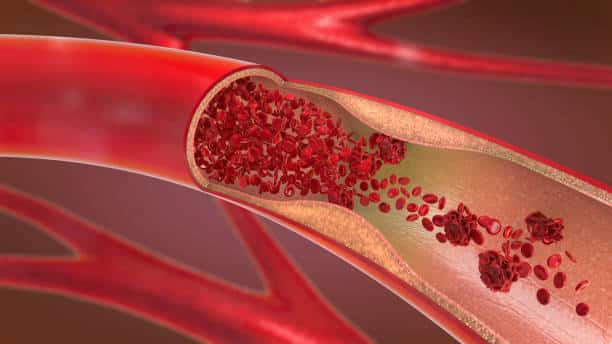 metabolic syndrome