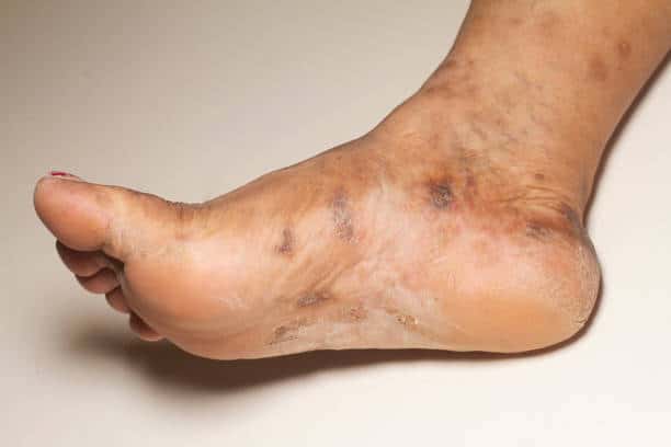 foot psoriasis
