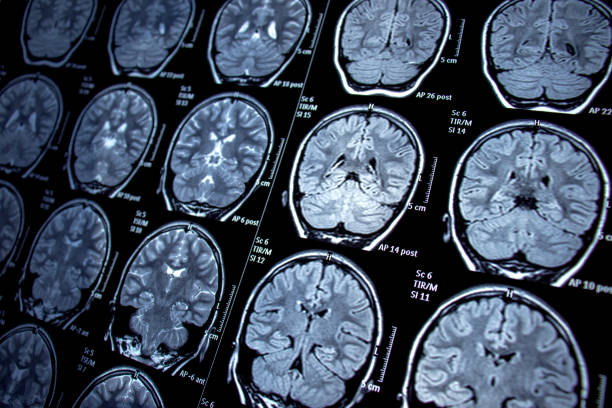 COVID brain