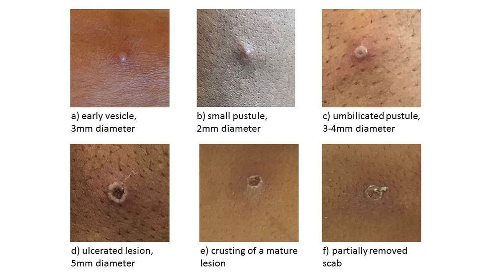 what is monkeypox