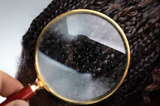 dandruff eczema or psoriasis 