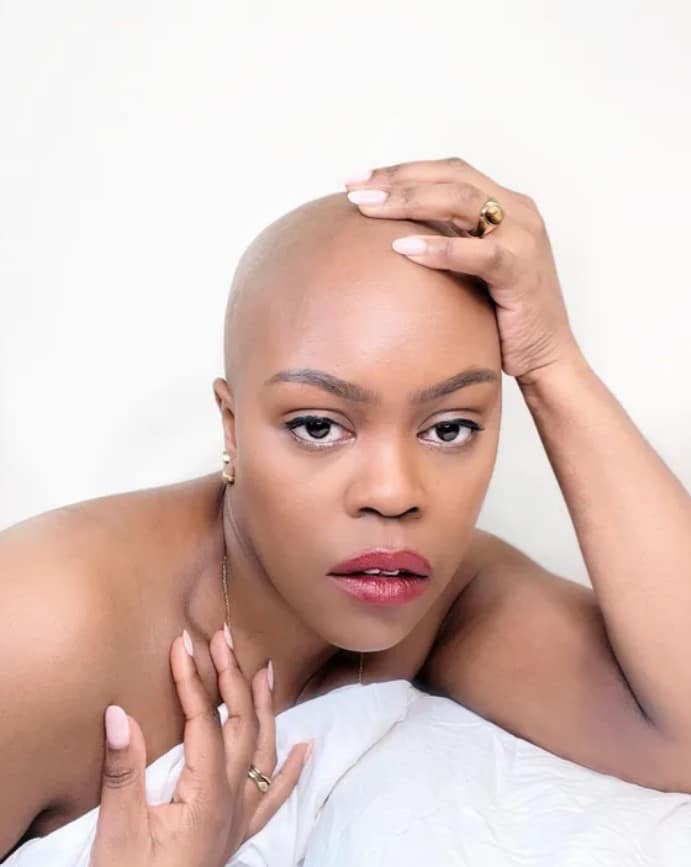 alopecia