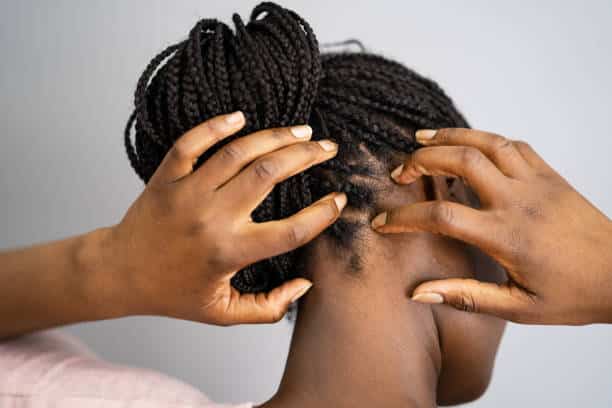 scalp psoriasis