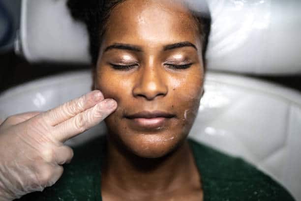 chemical peel