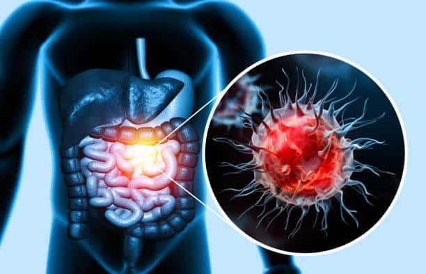 colon cancer