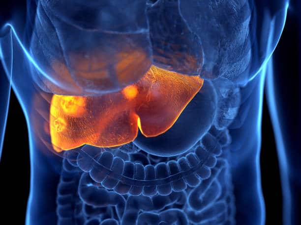 cirrhosis of the liver