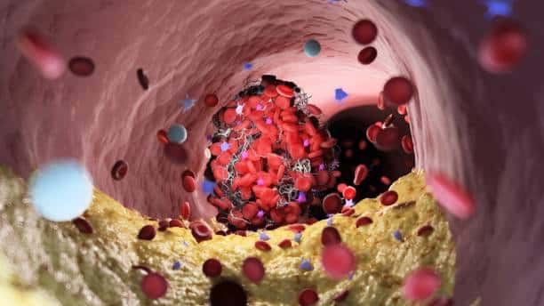 types of blood clots