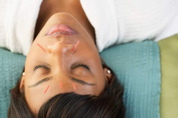acupuncture