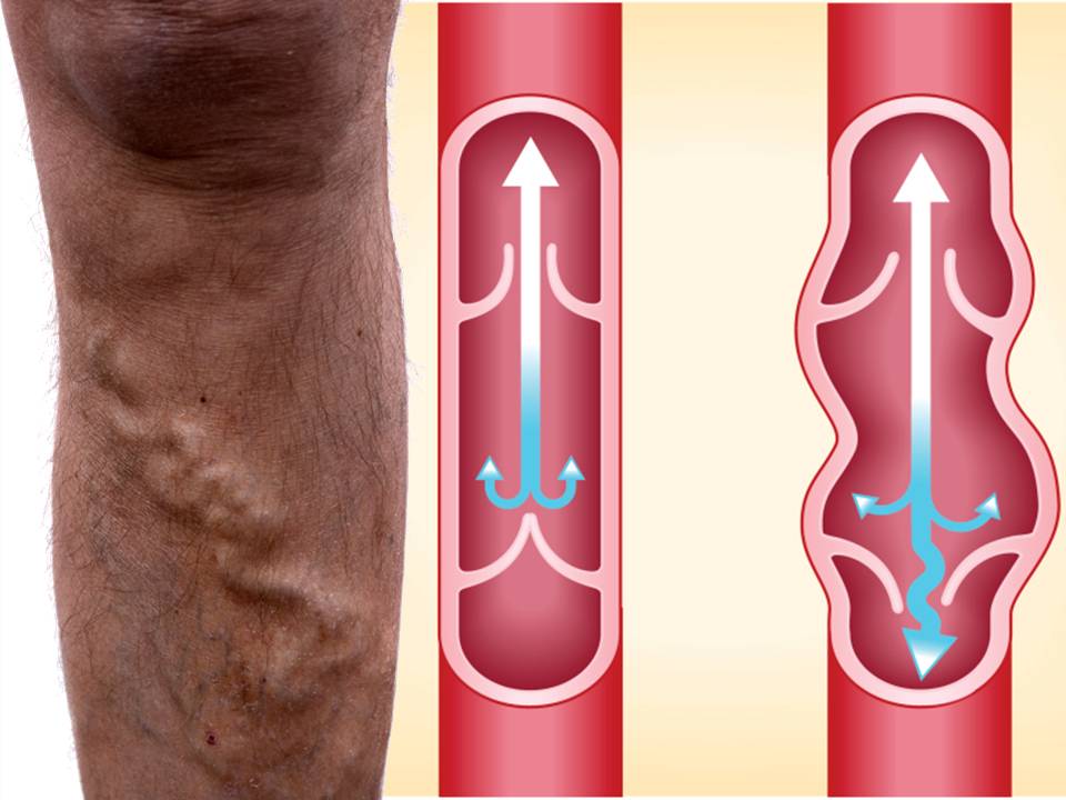 vein
