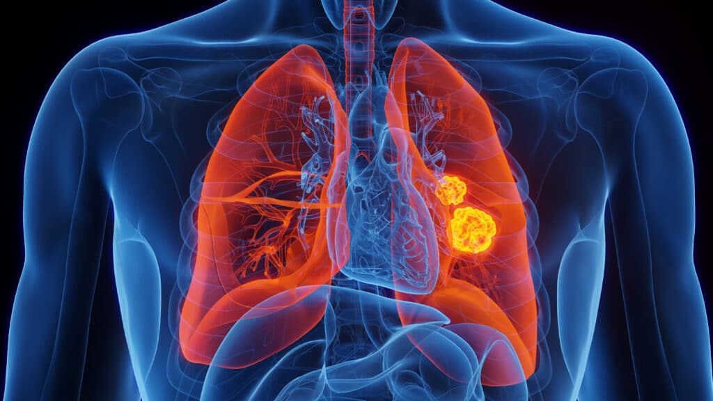 Black lung cancer cells may behave differently than white ones