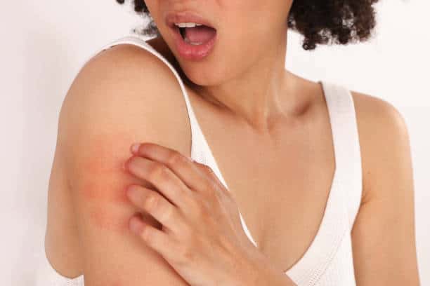 natural remedies for bug bites