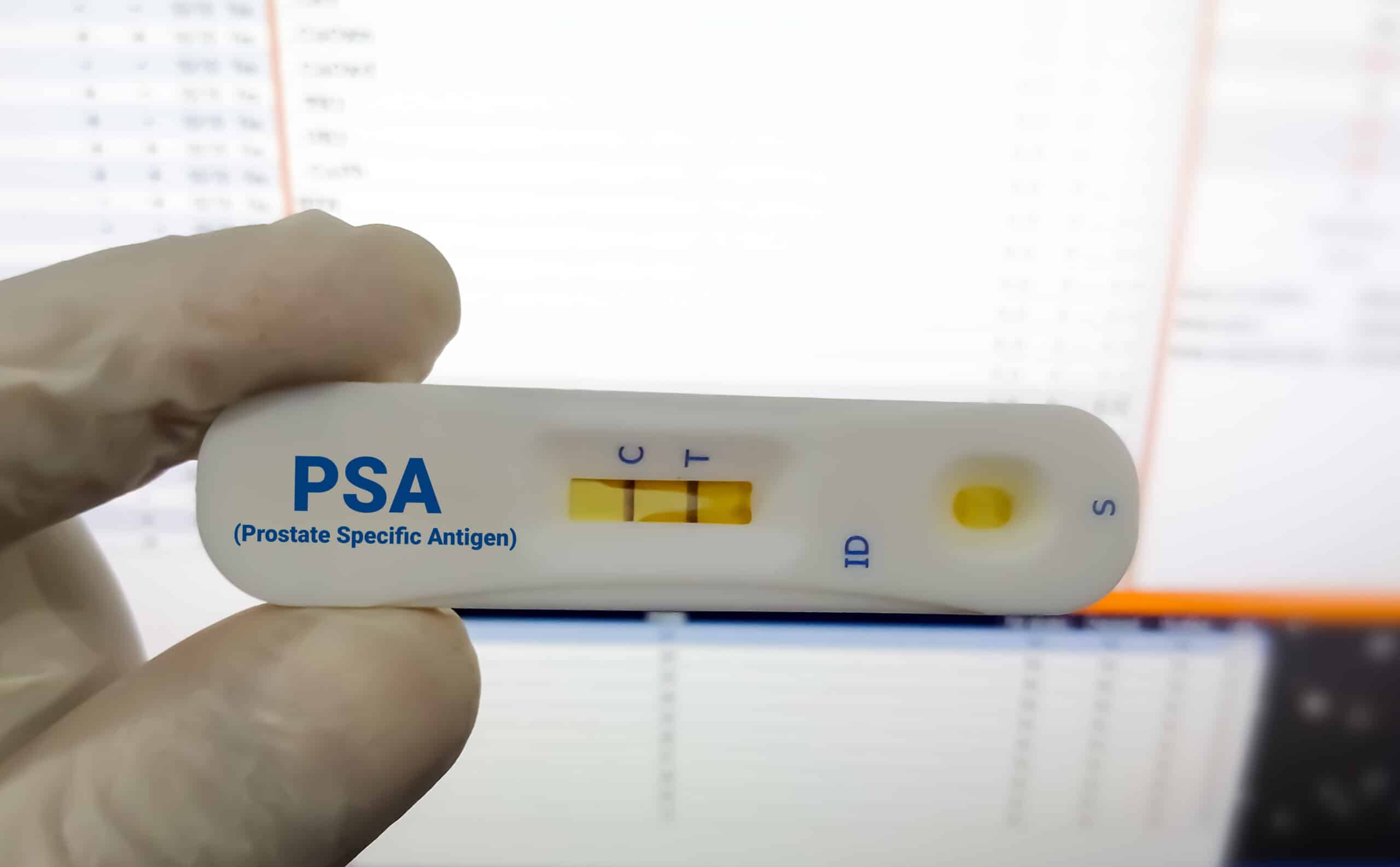 This Clinical Trial Showed Promise in Recurrent Prostate Cancer Patients