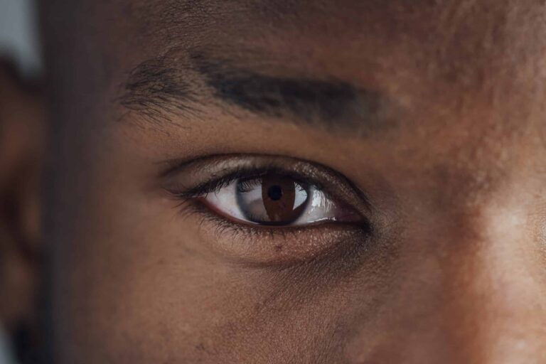 how to get rid of dark circles under eyes fast​