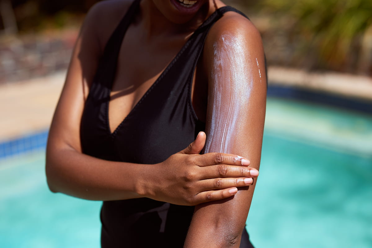 chronic hives, sunscreen