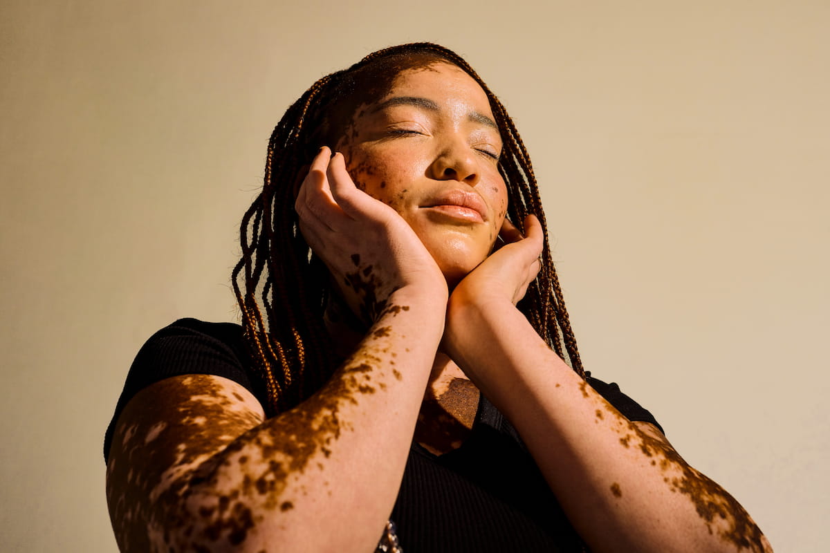 The Summer Style Guide Every Person With Vitiligo Needs